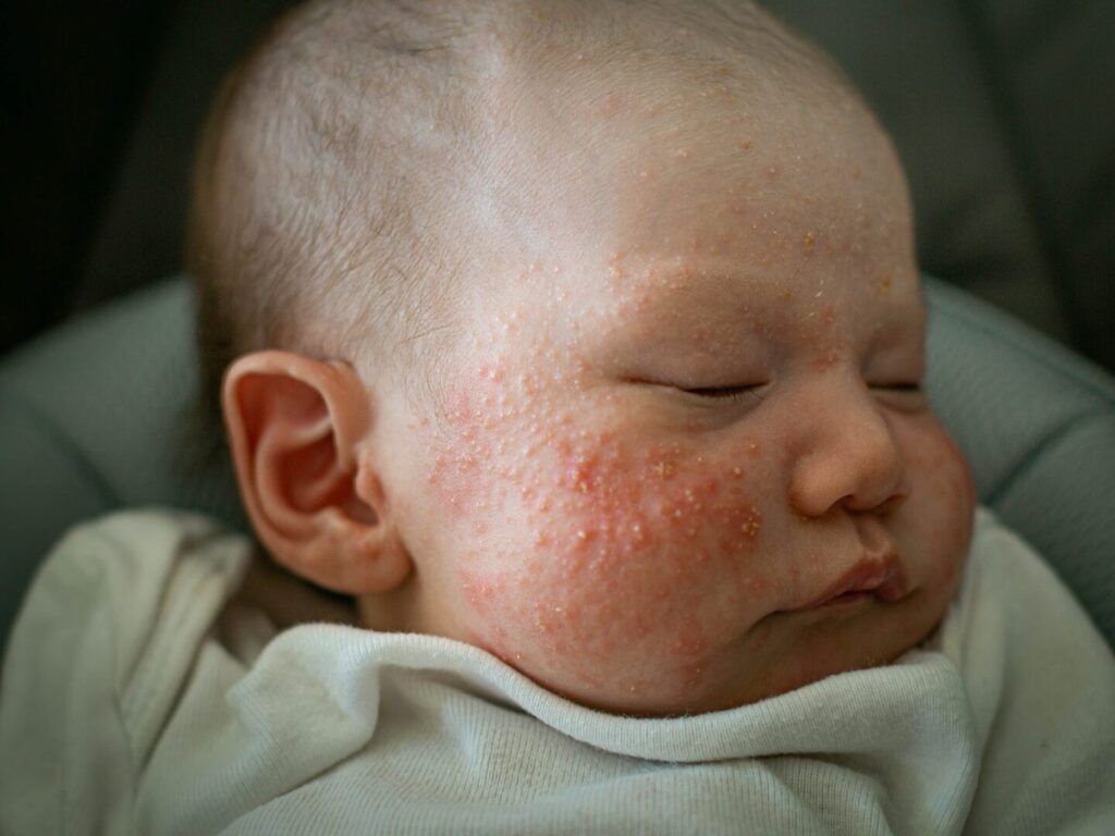 Un bambino con l'acne neonatale sul viso